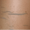 Fresh new skin after using exfoliating glove from Clear Medical