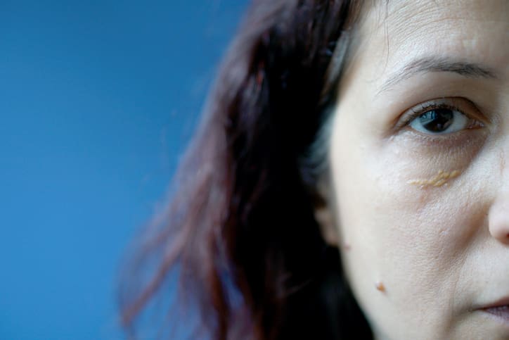 Plasma Xanthelasma Treatment