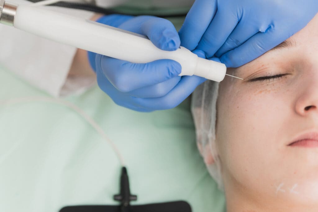 Plasma Skin Regeneration Treatment