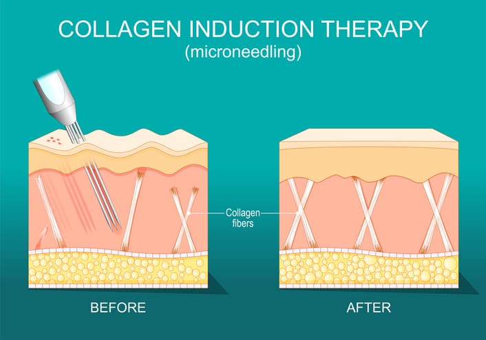 plasma fusion microneedling