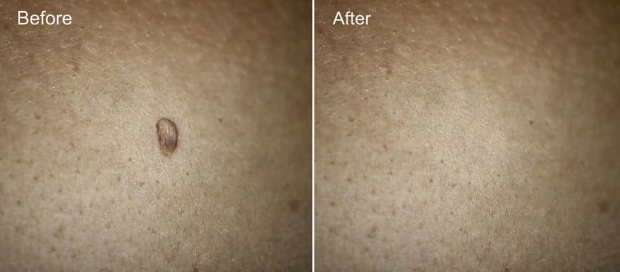 Plasma lesion removal treatment skin tag before and after